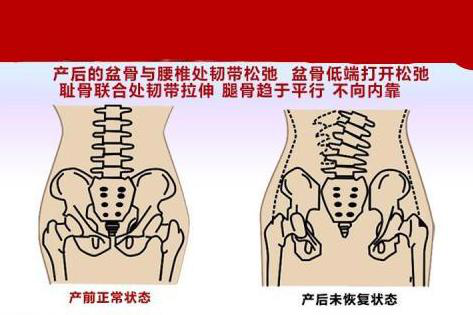 产后腰背痛