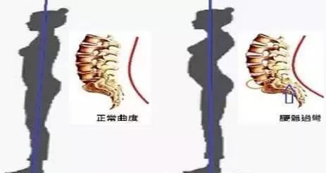 腹直肌分离