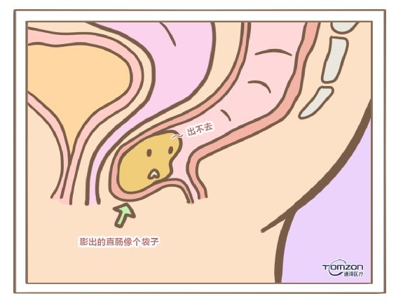 盆底肌修复仪器