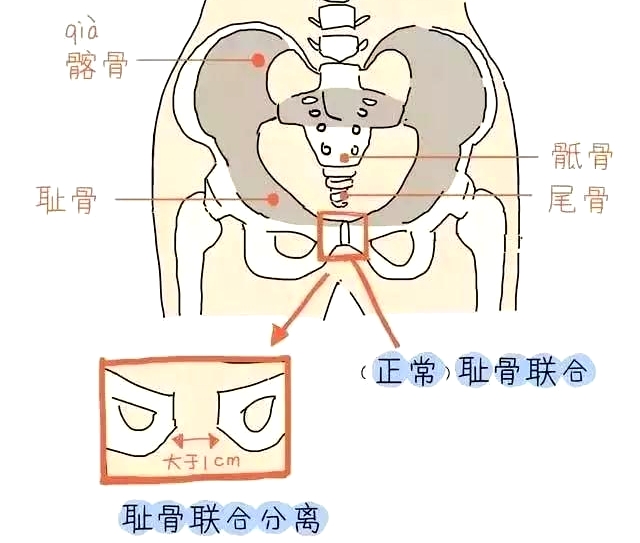 盆底康复训练