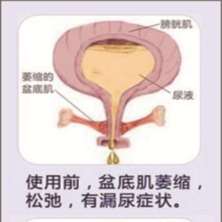 盆底功能障碍