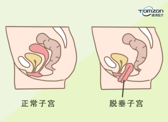 盆底肌修复仪器